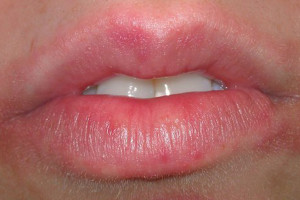 Presença de rachaduras e lesões nos lábios. 